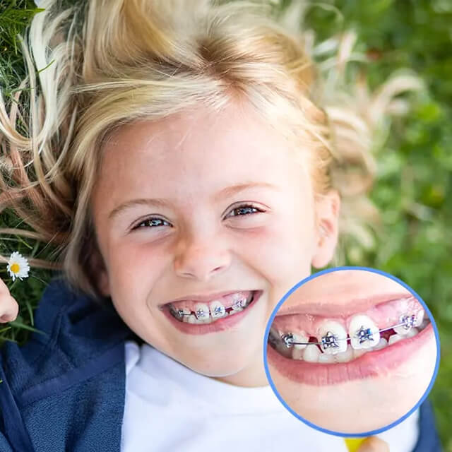 WildSmiles Braces - Platte River Orthodontics