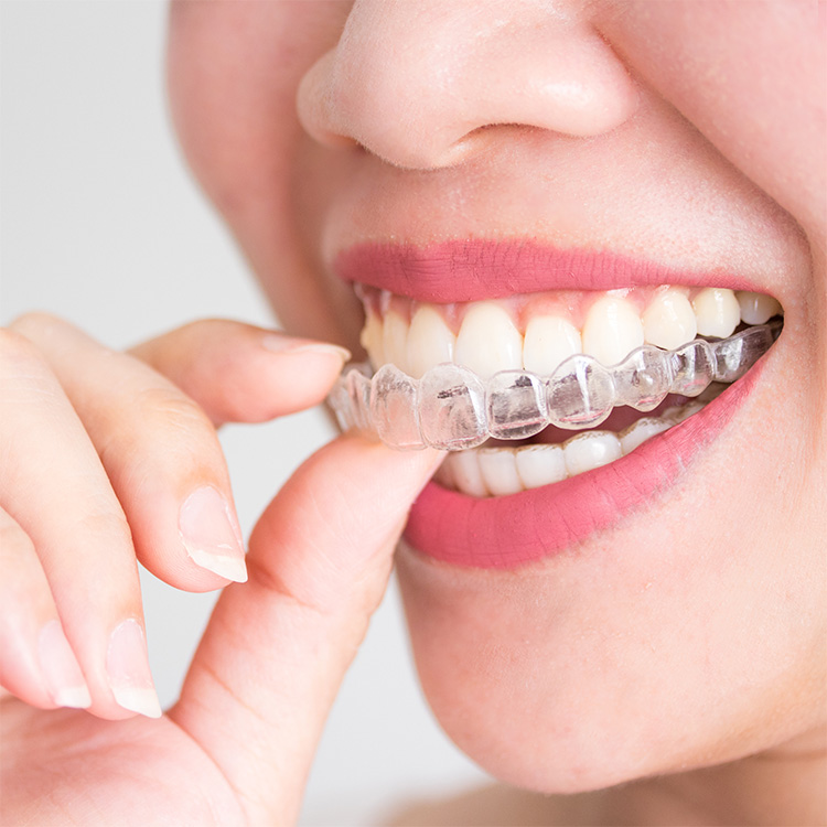 gretna-ne-invisalign-platte-river-orthodontics