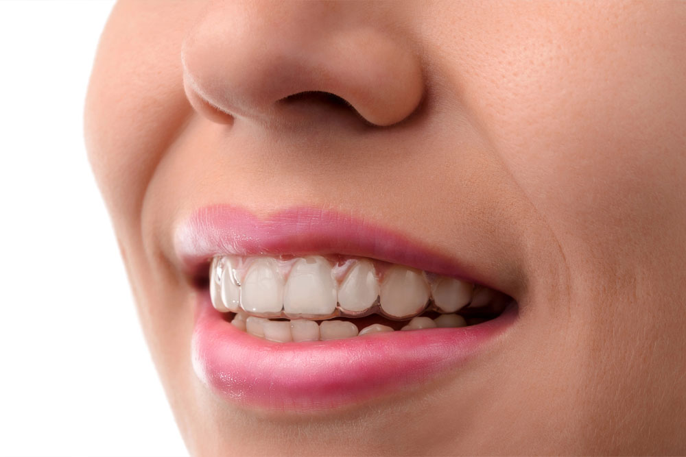 Smiling young woman wearing Invisalign